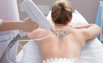 Laser Tattoo Removal